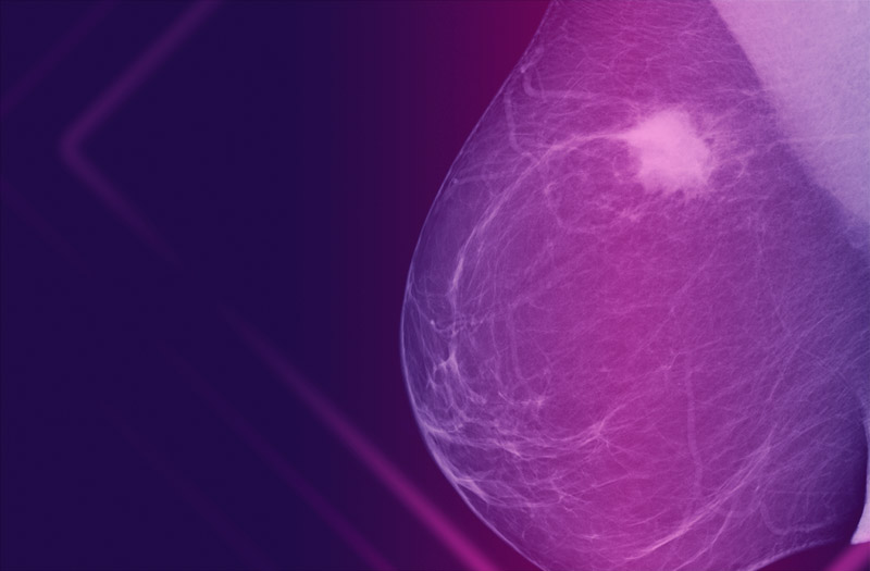 Lateral mammogram of female breast with tumor